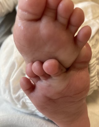 赤ちゃんの足汗
