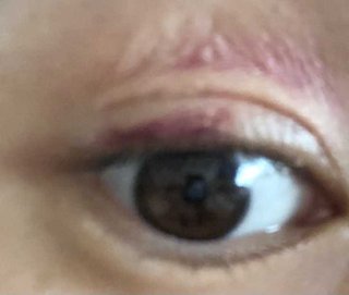 至急全切開整形経験者のかた教えてください