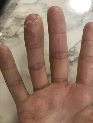 手湿疹酷すぎて（写真あり）