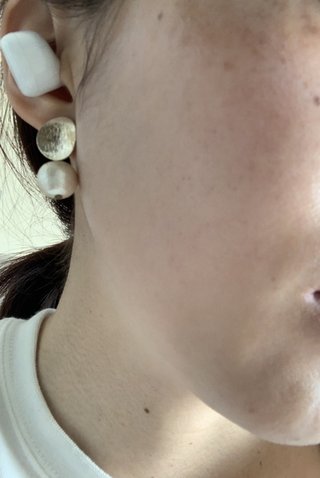 シミってどうしたら取れる？