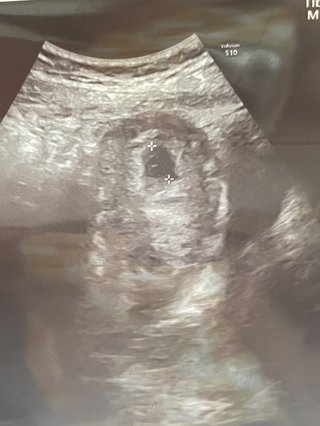 卵黄嚢と胎芽？？