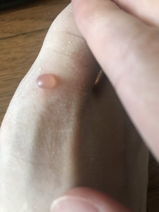 足にいくらみたいなパンパンなできものできた！