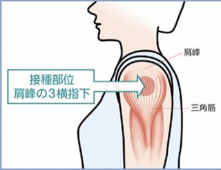 ワクチン接種で腫れた人、どこに打たれましたか??