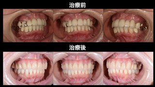 歯医者さんいますか 入れ歯の話