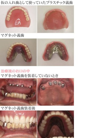歯医者さんいますか 入れ歯の話