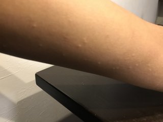最近腕とかに白いポツポツができる