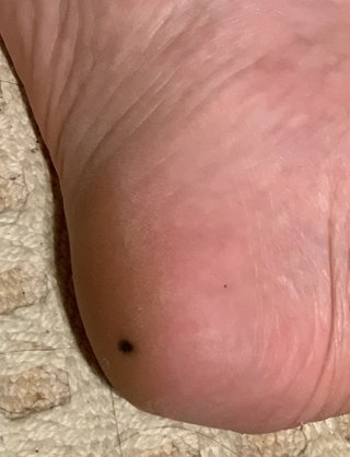 足裏に【急に現れた】ほくろ？メラノーマ？