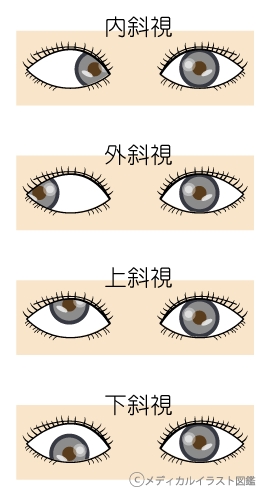 内斜視の人が羨ましい。可愛いよね。