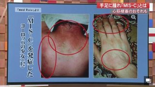 コロナ感染した子どもに“手足の腫れ”　血管が炎症、悪化すると心筋炎や心筋梗塞の恐れも【高知発】