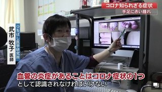 コロナ感染した子どもに“手足の腫れ”　血管が炎症、悪化すると心筋炎や心筋梗塞の恐れも【高知発】
