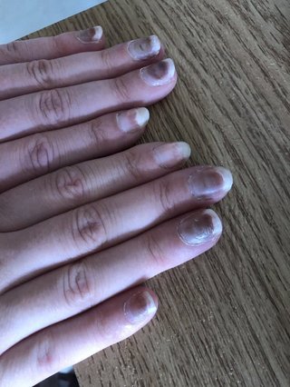 うわ、  ワクチン接種後、62％が血栓