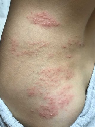 帯状疱疹ですかね？？