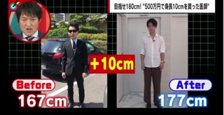 身長167cmだった男性、500万円で10cm伸ばす手術して人生変わる
