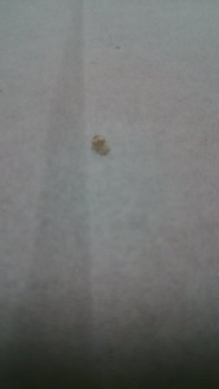 リンゴ酢で首イボ