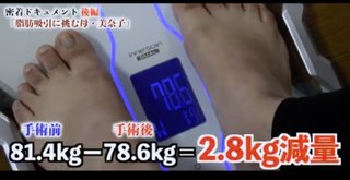 美奈子の脂肪吸引の動画見たら太らないって決めた