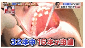 お笑いコンビ「ウエストランド」の井口浩之さんの二重歯列（二枚歯）の歯列…