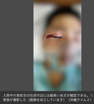 母親「何が原因だった。事実を明らかにしてほしい」高校生、警官と接触で右目失明(沖縄)