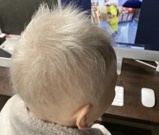 【ワクチンの副反応】髪の毛など全ての体毛が脱けた20代女性、新たに真っ白な髪の毛が生える