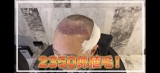 トルコで植毛手術のいしだ壱成、最新ショット公開