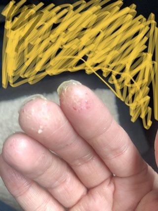 手荒れ　手湿疹