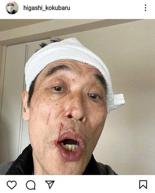 グロ注意　東国原英夫　人間ドック後、麻酔で足元ふらつき転倒→看板に顔面打でケガ