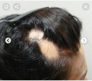 コロナ後遺症脱毛とは、急増中