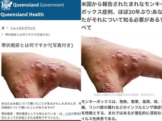 【中共の傀儡・WHO】ワクチンの副反応「帯状疱疹」を「サル痘」と称し、捏造ww 