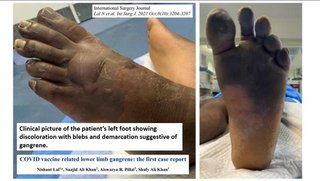 閲覧注意、32才の健康な男性は、ワクチン接種後、足に血栓ができた