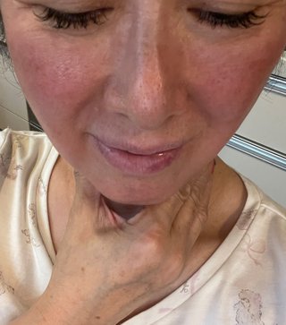 元おニャン子・内海和子、顔が真っ赤になる謎の症状を報告「数日まえから透明なポツポツが」