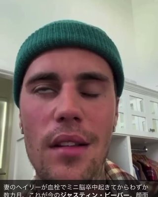 ワクチン打ってジャスティンビーバーが顔面神経麻痺