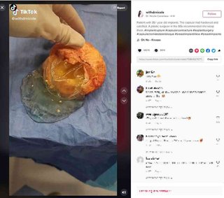 まるでさつま揚げ！　破損し除去した35年超の豊胸バッグに衝撃（米）＜動画あり＞