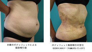 脂肪吸引