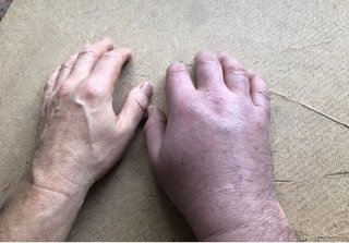 ワクチン打ったパートナーの手です、腕はとても腫れていて、通常のサイズの3倍でした