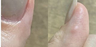 約1年前にガラステーブルが爆発してガラスが親指に刺さったんだけど