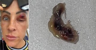【グロ注意】顔の吹き出物を潰した女性、寄生虫のような異物が飛び出して愕然（英） 