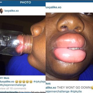 海外で流行ってる空き瓶を吸引して唇を厚くする