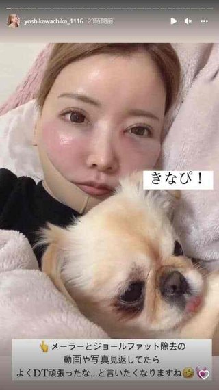 2000万整形双子モデル妹、壮絶ダウンタイム公開　顔面変色、頬パンパンに腫れ上がり...