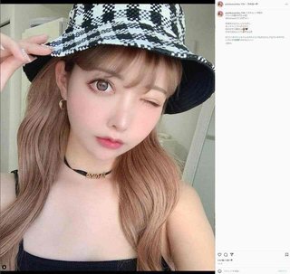 2000万整形双子モデル妹、壮絶ダウンタイム公開　顔面変色、頬パンパンに腫れ上がり...