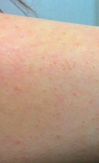 二の腕のブツブツなんとかならないですか？