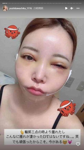 2000万整形双子モデル妹、壮絶ダウンタイム公開　顔面変色、頬パンパンに腫れ上がり...