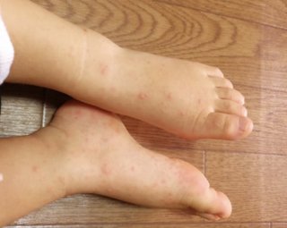 【手足口病はワクチンの副反応】東京都内で手足口病の急増 