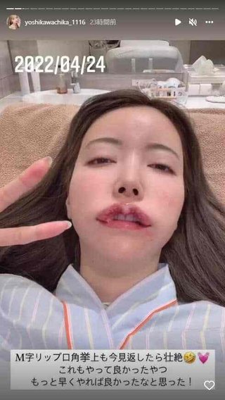 2000万整形双子モデル妹、壮絶ダウンタイム公開　顔面変色、頬パンパンに腫れ上がり...