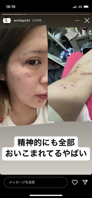 “大荒れ投稿”の坂口杏里さん、不調原因は「帯状疱疹」だったと告白「緊急でドクターが家まで来て」 