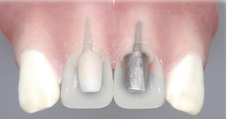 40歳　歯が抜けたー。この年齢で誰かいる？