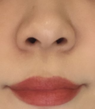 来月額のヒアルロン酸と鼻に糸入れて唇もヒアルロン酸入れてくるよ