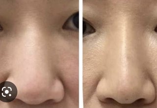 来月額のヒアルロン酸と鼻に糸入れて唇もヒアルロン酸入れてくるよ