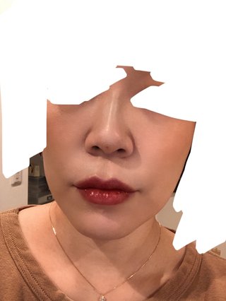 今日整形してきたよ