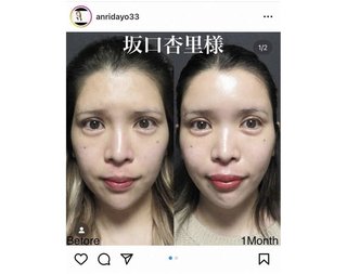 坂口杏里さん“全顔整形”告白で「大満足」衝撃ビフォーアフターに「こんなに変わるんだ」の声