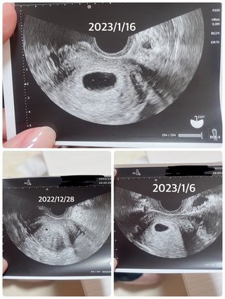 胎芽確認が出来ません