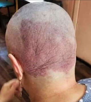 ワクチン接種後に免疫システムの障害から乾癬を患い、精神病を発症した女性の深刻なケース